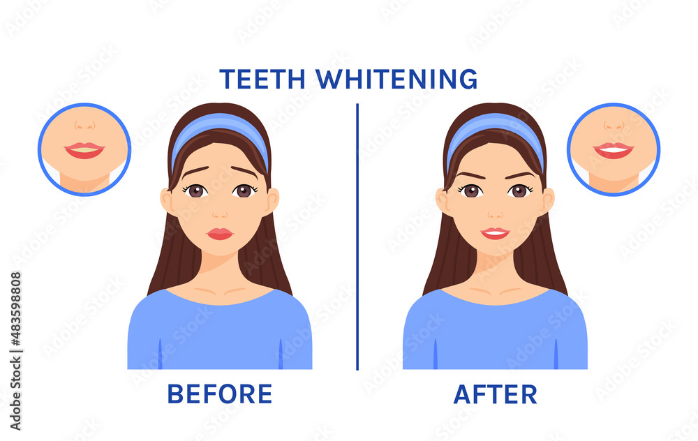 Teeth Whitening. Woman with Yellow Teeth at Dentist. Dental Treatment. Before After. Healthy White Teeth and a Happy Face with Smile. Cartoon style. Vector illustration for Medical and Dental design.