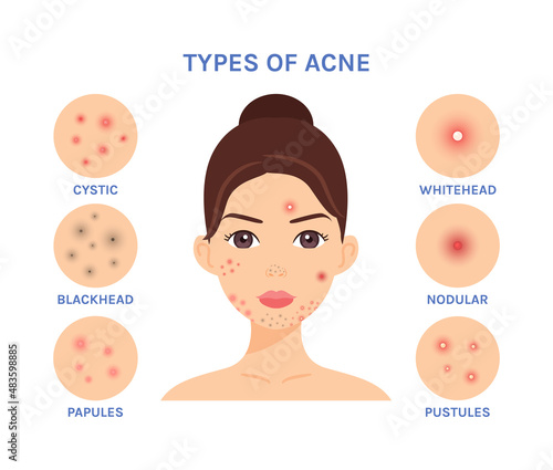 Isolated Pretty Brunette Woman with Problem Skin on Face. Teenager with Pimples. Zoom. Types of Acne. Flat Color Cartoon style. White background. Vector illustration for Medical and Cosmetology design