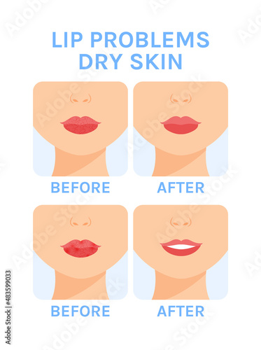 Female Lip problems. Dry skin. Care and Treatment for Beautiful lips. Before After. Healthy Soft lips. Smile and Happy on Lips. Cartoon style. White background. Vector illustration for Medical design.