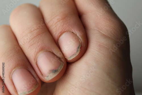 damaged damaged nail without manicure with dirt close-up. Nail Health Care