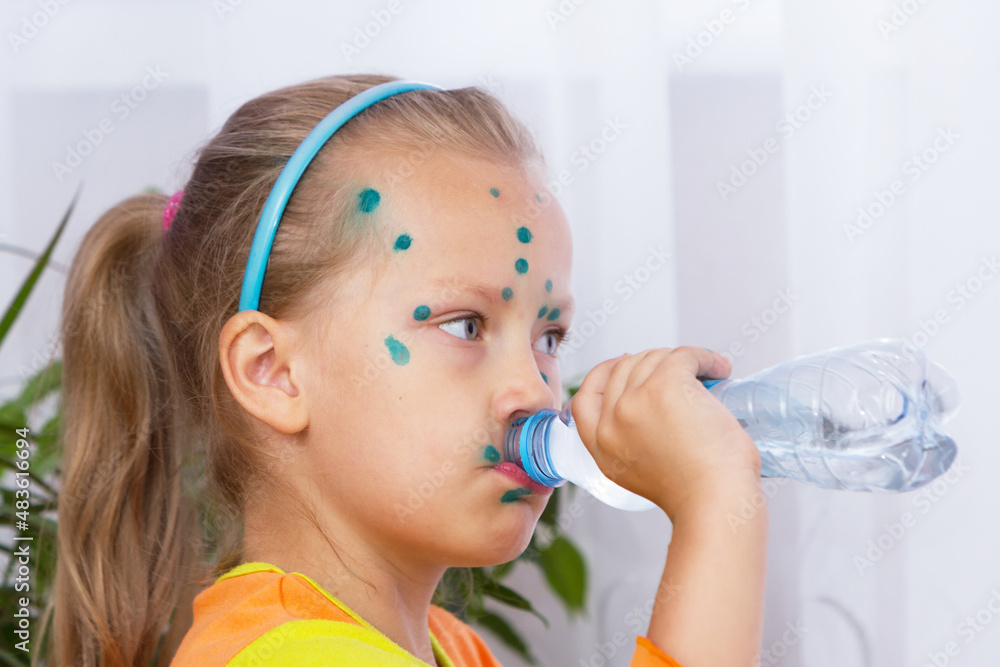 Portrait of a little girl suffering from chickenpox Portrait of a little girl suffering from chickenpox
