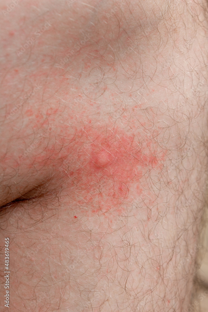 Fototapeta premium Inflamed Mosquito bite on a caucasian man's leg
