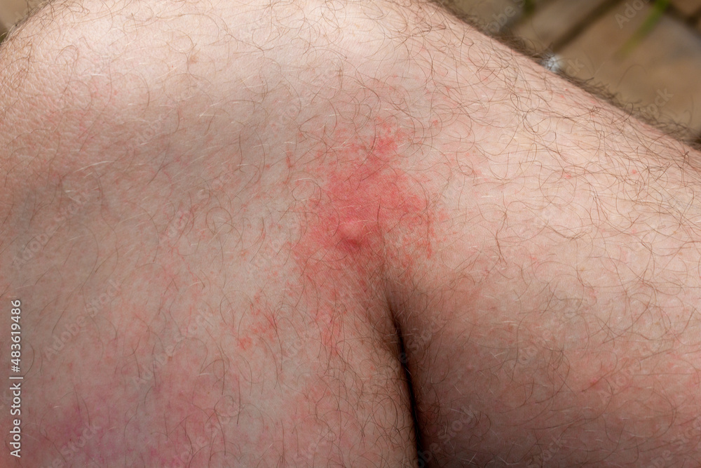 Fototapeta premium Selective focus on a mosquito bite on a caucasian man's leg
