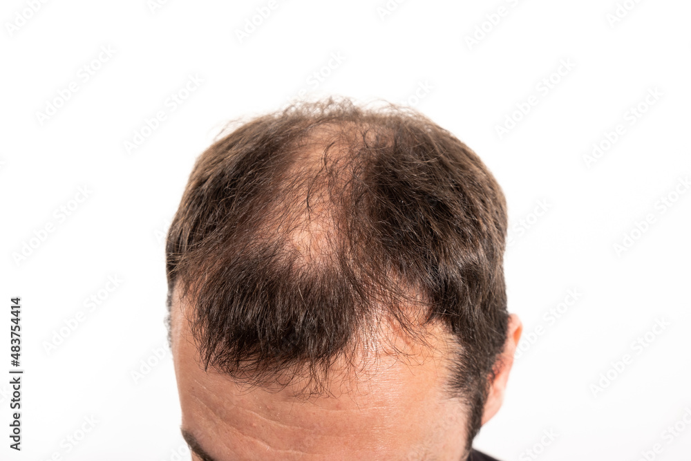 Close-up balding head of a young man on a white isolated background. Close-up balding head of a young man on a white isolated background.