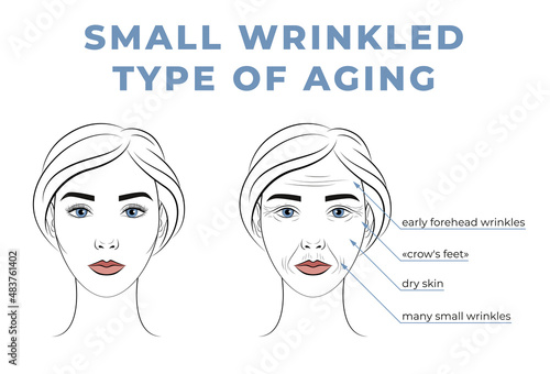 Small wrinkled type of aging on the face. The face of a woman in her youth and old age.