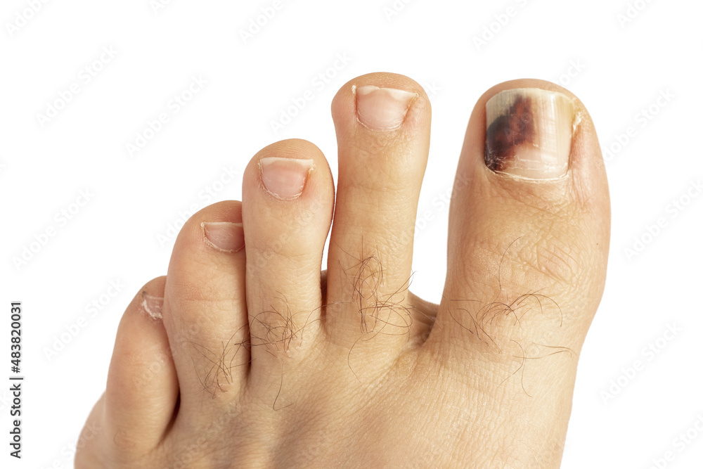 Injured toenail. Purple toenail on big toe. Stock Photo Adobe Stock