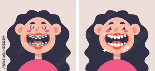 Bracket system before after concept. Vector flat graphic design cartoon illustration
