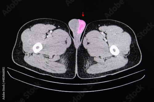 A CT scan of a patient with testicular cancer.