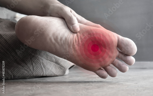 Cuadro en lienzo Concept of nail prick and cellulitis in foot of Asian man