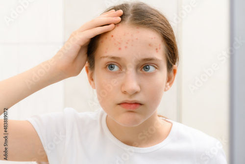 portrait of a teenage girl touches her face with pimples, acne on the skin