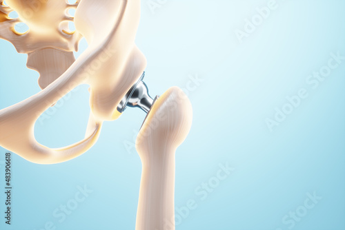 Medical poster image of a hip implant. artificial joint, Arthritis, inflammation, fracture, cartilage. 3D illustration, 3D render. photo