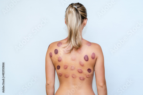 Woman after a vacuum massage with cans. Acupressure of the back. Hematomas after vacuum treatment of the back