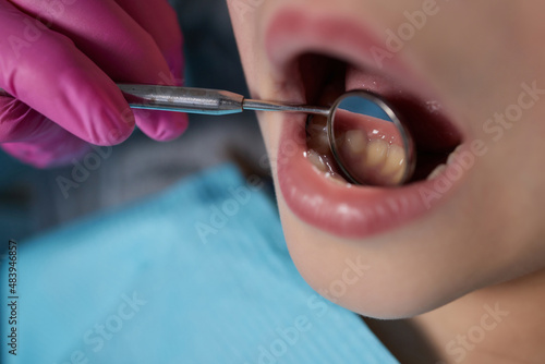 A close-up of a young girl getting a dental exam by dentist and using dental mirror to see baby teeth and gums. photo