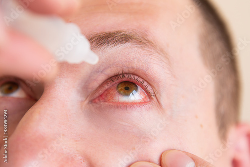 Take care of his eyes. Portrait of a young man with a very red eye dripping drops into his eyes. Close-up.