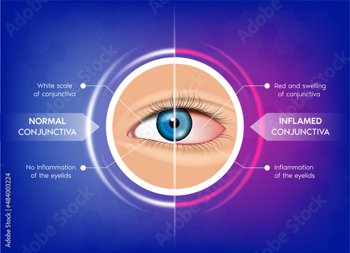 Normal conjunctiva and Conjunctivitis.
