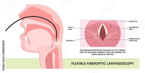 Sore loss cough virus viral acute swell sound folds treat cysts Palsy nerve Tumor botox throat hoarse larynx airway polyps Cancer injury speech damage Ulcers box chronic nodules surgery reflux upper