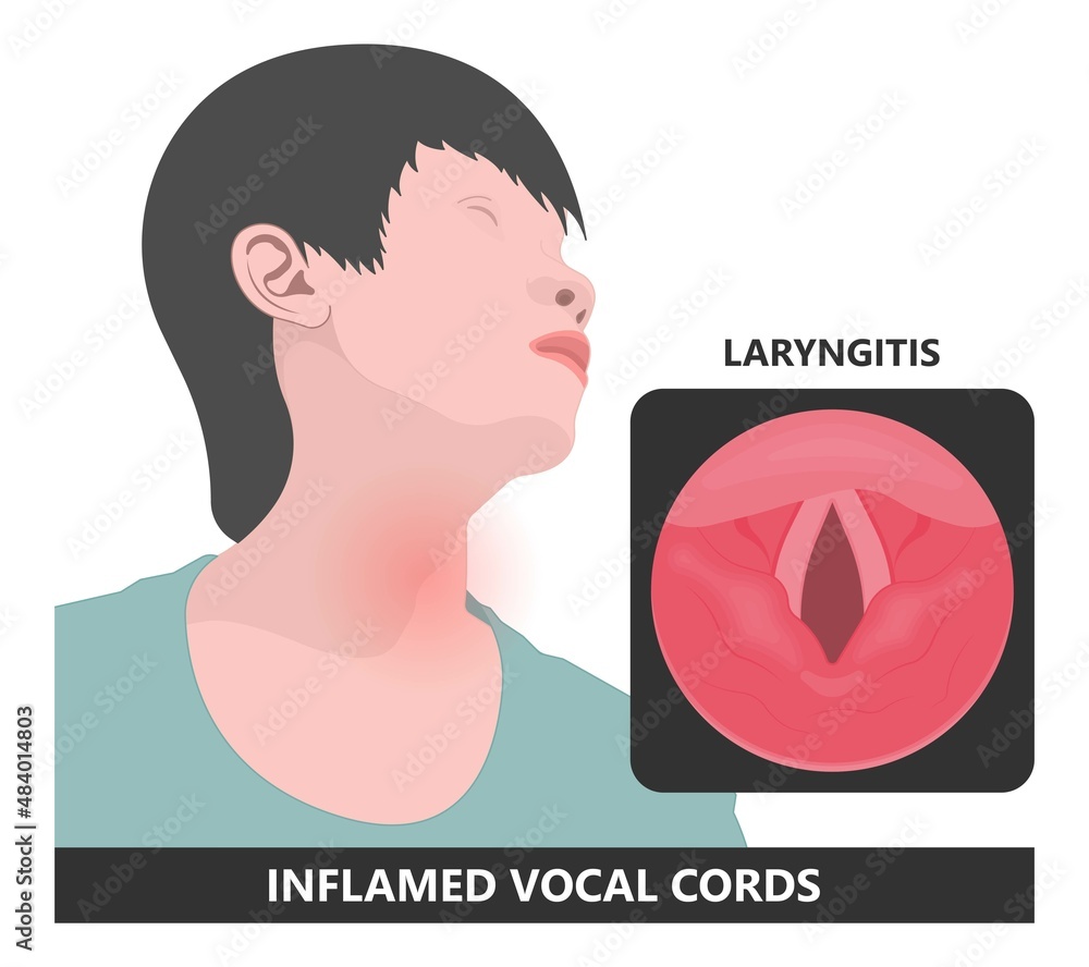 Vettoriale Stock Sore loss cough virus viral acute swell sound folds
