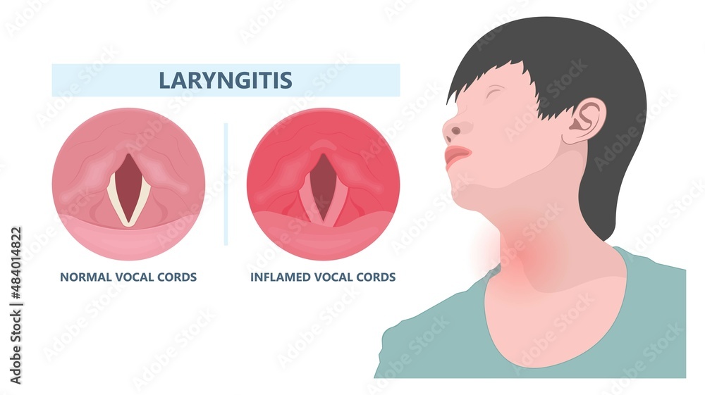 Sore loss cough virus viral acute swell sound folds treat cysts Palsy