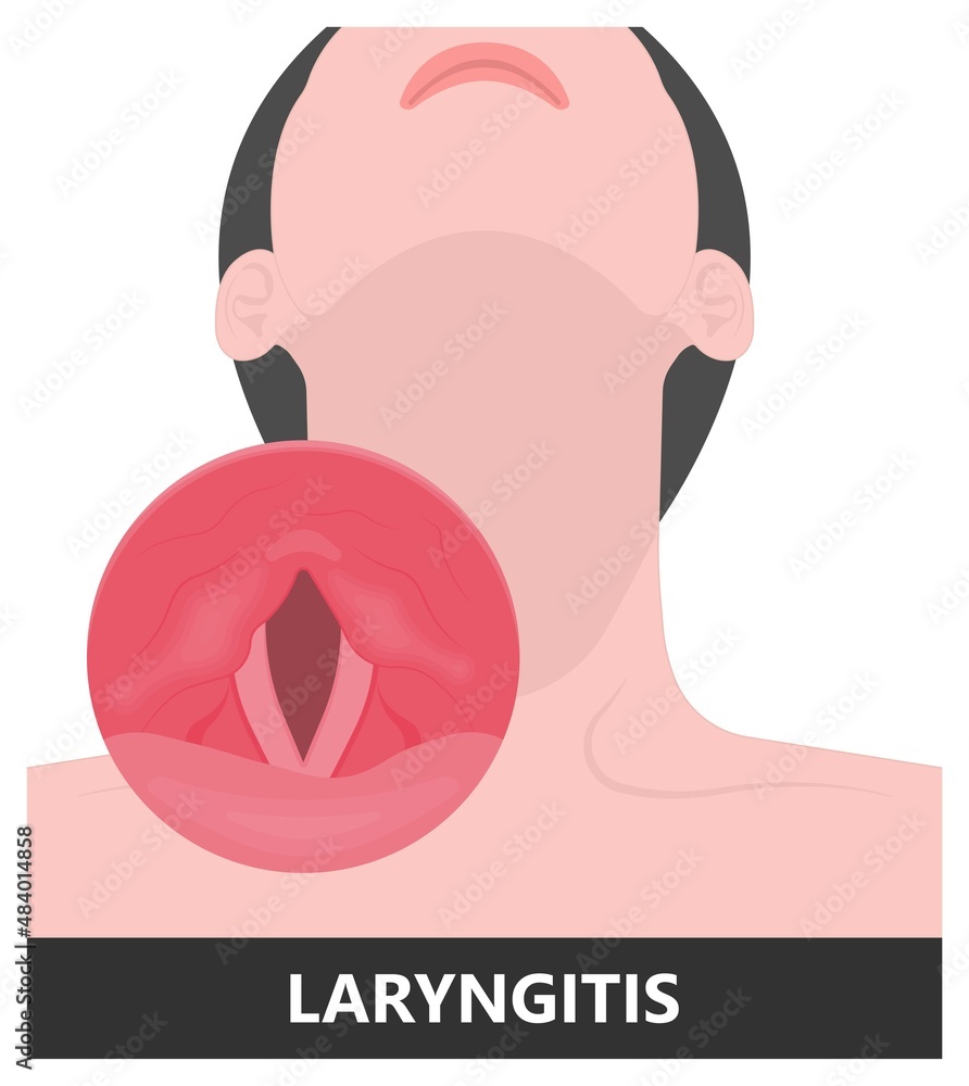 Sore loss cough virus viral acute swell sound folds treat cysts Palsy