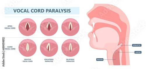 Sore loss cough virus viral acute swell sound folds treat cysts Palsy nerve Tumor botox throat hoarse larynx airway polyps Cancer injury speech damage Ulcers box chronic nodules surgery reflux upper