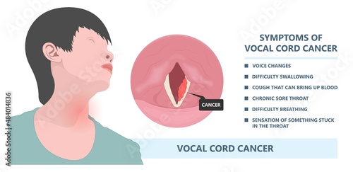 Sore loss cough virus viral acute swell sound folds treat cysts Palsy nerve Tumor botox throat hoarse larynx airway polyps Cancer injury speech damage Ulcers box chronic nodules surgery reflux upper