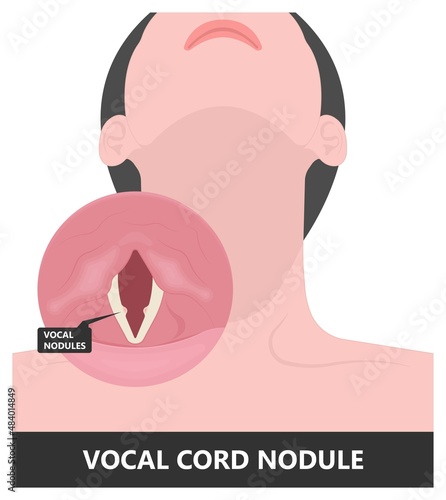 Sore loss cough virus viral acute swell sound folds treat cysts Palsy nerve Tumor botox throat hoarse larynx airway polyps Cancer injury speech damage Ulcers box chronic nodules surgery reflux upper