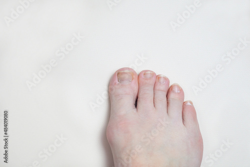 the foot of an adult with a bump and long nails