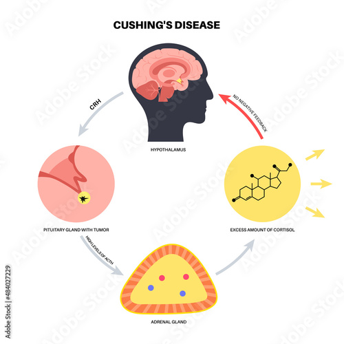 Cushing Desease poster