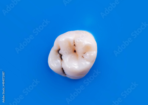 tooth with deep cavity , pictured before starting treatment