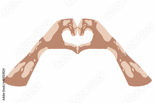 Hands with vitiligo disease. Support for people with skin pigmentation disorders. Heart, self-love and body positive. Light skin, mutalka. Body positive. Hand drawn illustration. Vector