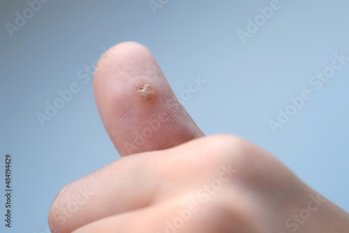 Big wart, verruca on human thumb finger before laser removing on grey backgroung, closeup view. Human papillomavirus, weakened immunity, treatment of warts. An infectious disease.