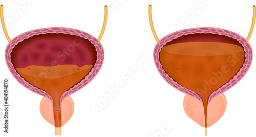 Benign prostatic hyperplasia