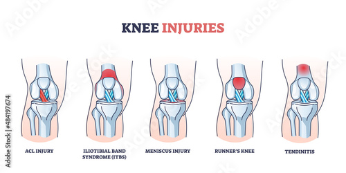 Knee injuries with medical bone, ligament or muscle trauma outline diagram. Labeled educational inflammation disease collection vector illustration. ACL injury, meniscus, runners or tendinitis example