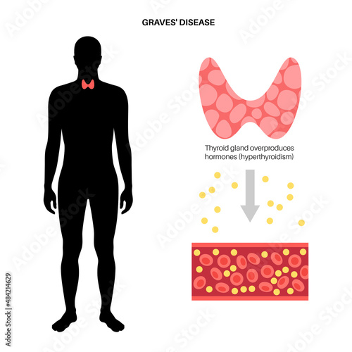 Graves desease symptoms photo