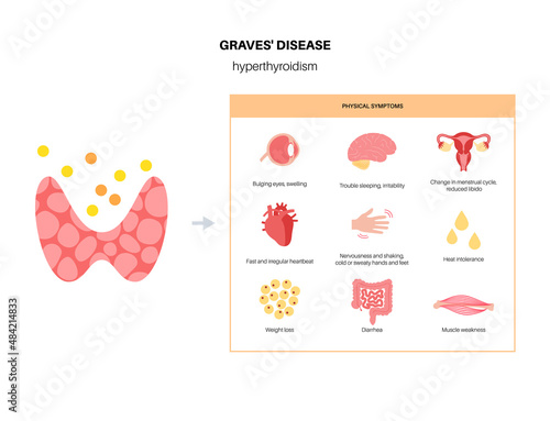 Graves desease symptoms photo