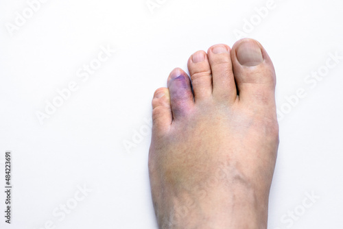 Injured foot with broken toe on white background