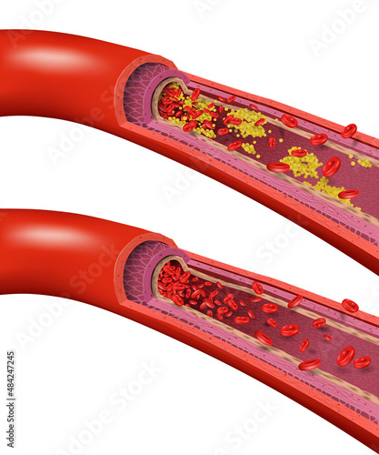 Healthy and Cholesterol Blocked Blood Vessels, medical concept