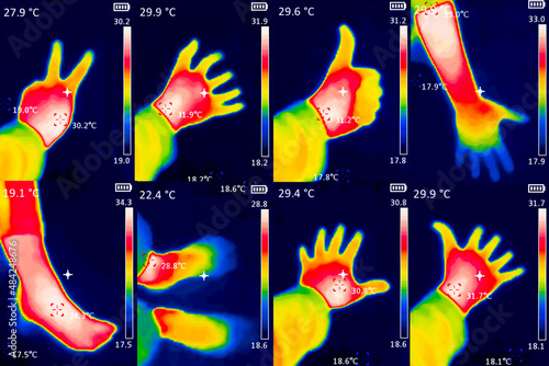 Bilde på lerret A thermographic image of a person's hand showing different temperatures in different colors, from blue indicating cold to red indicating hot, this may indicate inflammation of the joints