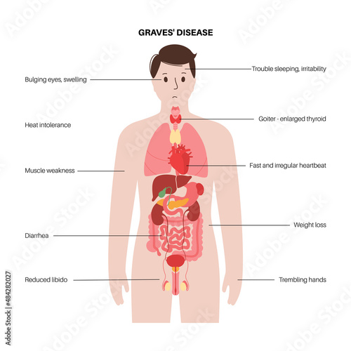 Graves desease symptoms