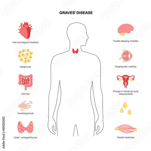 Graves desease symptoms photo