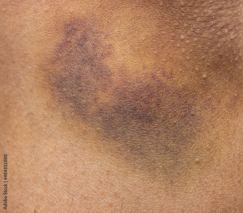 bruise on the skin of the leg as a background bruise on the skin of the leg as a background
