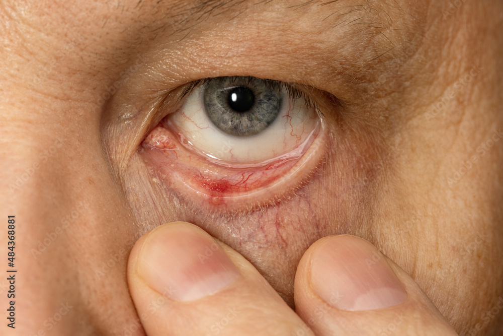 Fototapeta premium Eye of a man, inflamed conjunctiva, close-up. Eye diseases.
