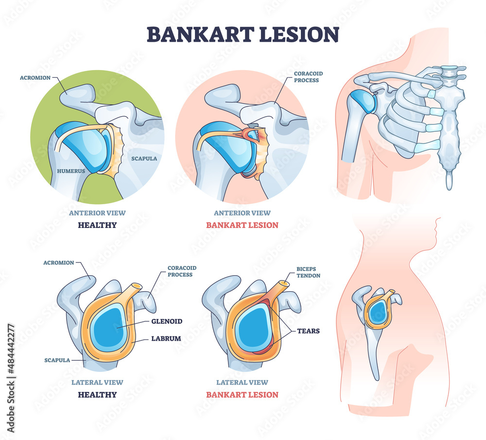 Bankart lesion as anterior part of the glenoid labrum trauma outline diagram. Labeled educational medical injury type with anterior and lateral view of xray with bones and tears vector illustration.