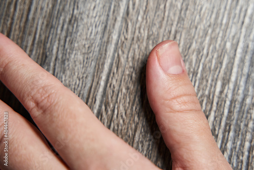 onycholisis. damage to the nail on the hand. exfoliation of the nail plate at the points of growth photo