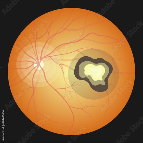 Toxoplasmosis cyst Fecal life cycle cat retina eye hiv aids mother child retina pet women animal faece poop fetal birth defect T. gondii poo meat pork virus fungi