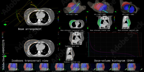 The overview shows beam configurations, dose calculations and dose distributions for postoperative radiotherapy of a breast cancer patient. photo