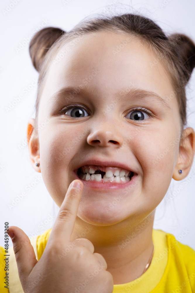 Excited little girl with opened mouth pointing at missing front baby tooth with finger in yellow t-shirt on white background. First teeth changing. Going to dentist to do tooth treatment. Excited little girl with opened mouth pointing at missing front baby tooth with finger in yellow t-shirt on white background. First teeth changing. Going to dentist to do tooth treatment.