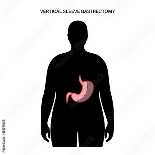 Laparoscopic sleeve gastrectomy