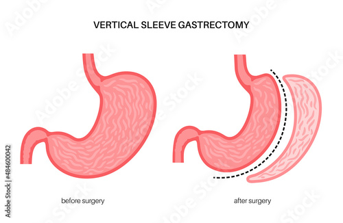 Laparoscopic sleeve gastrectomy