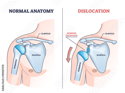 Shoulder dislocation and humerus bone trauma explanation outline diagram. Labeled educational medical injury when skeletal part rotates out of scapula vector illustration. Painful arm vs healthy. photo